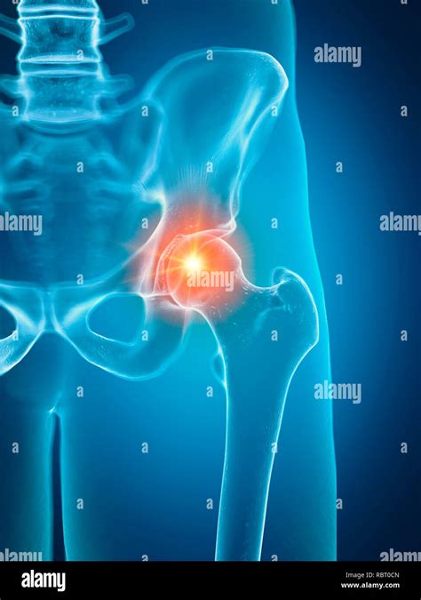 Illustration Of A Painful Hip Joint Stock Photo Alamy