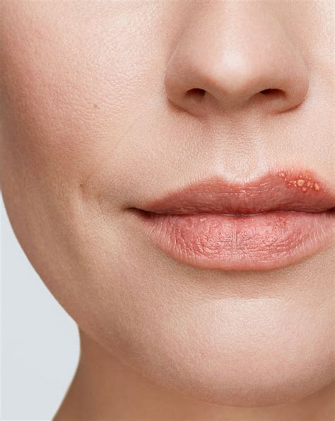 Cold Sore Stages Get Rid Of A Cold Sore Abreva