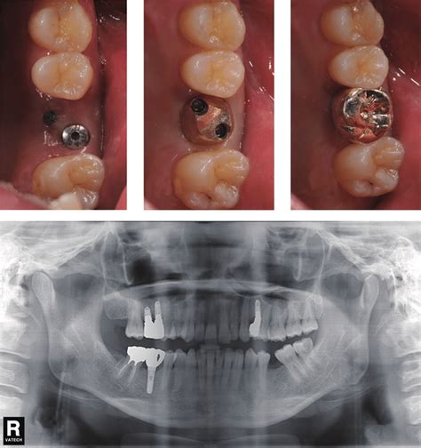 Two Short Implants 2si Supporting Single Molar Restoration In