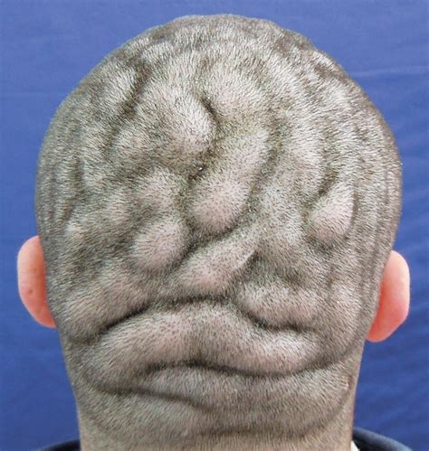 Condition Makes Man S Scalp Look Like Surface Of Brain NBC News