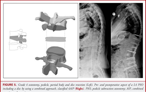 Figure 1 From The Comprehensive Anatomical Spinal Osteotomy