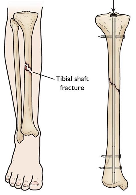 Tibial Shaft Fracture Causes Types Symptoms Diagnosis Treatment Prognosis
