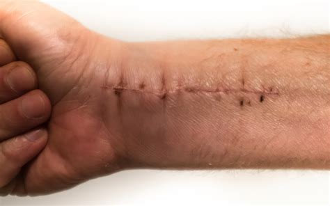 Arthroscopic Wrist Surgery Knoxville Tn