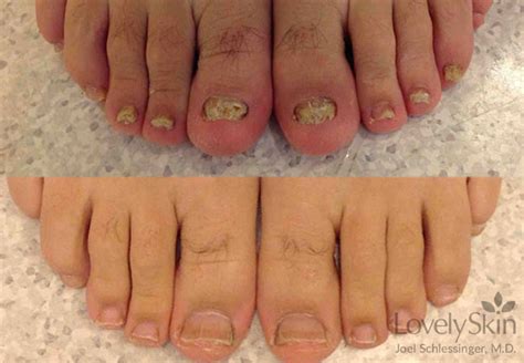 Toenail Fungus Before And After Photos Skin Specialists