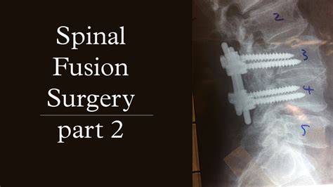 Spinal Fusion Surgery Pt 2 Youtube