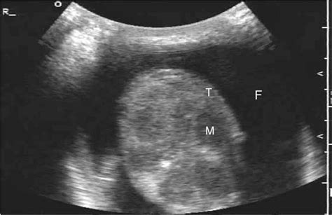 Figure 16 From Testicular Ultrasound Semantic Scholar