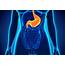 Gastroparesis A Mysterious Stomach Disorder That’s On The Rise In 