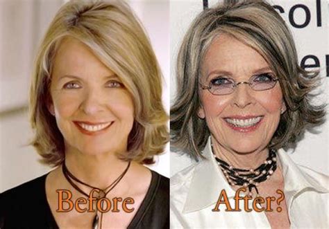 Diane Keaton Plastic Surgery Before And After Facelift Photos Diane