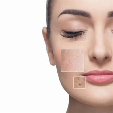 How To Get Rid Of Dark Spots On Your Skin Cause Treatment Prevention