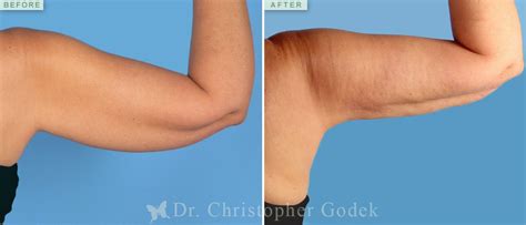 Arms Liposuction Before And After Photos Arm Liposuction Liposuction