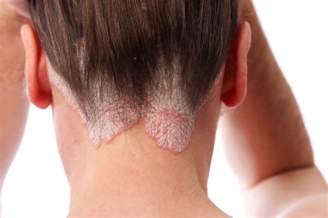 Red Patches On Scalp Vlrengbr