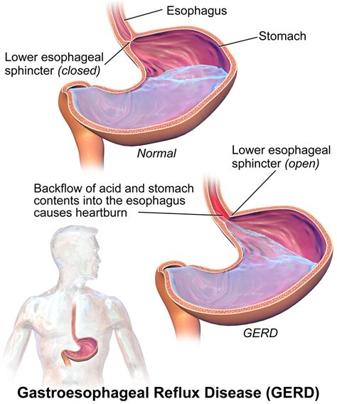 Gastroesophageal Reflux Disease The Patient Guide To Heart Lung And