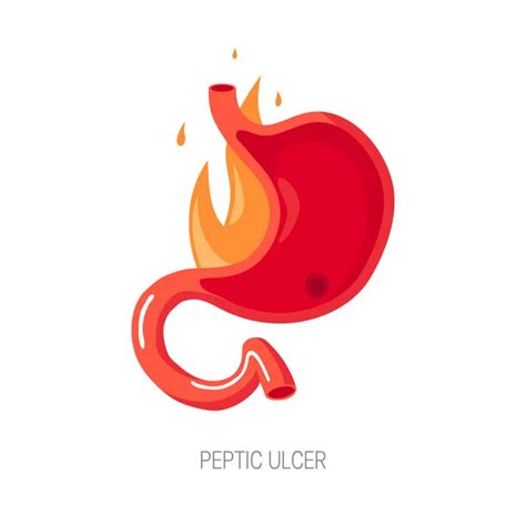 Peptic Ulcer Vector Art Stock Images Depositphotos