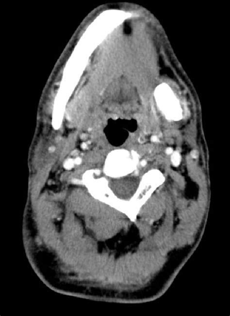 Figure 1 From Giant Sialolith Of Submandibular Gland Report Of A Case