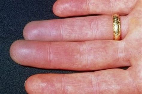 raynaud s disease the strange condition that leaves your hands red white and blue liverpool