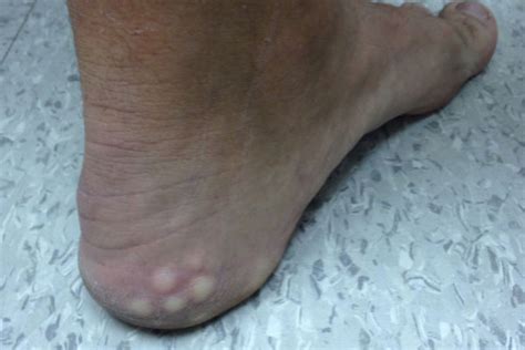 Clinical Challenge White Lumps On Heel When Standing Mpr