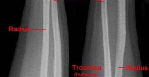 Normal Forearm X Ray X Ray Pinterest Radiology Rad Tech And