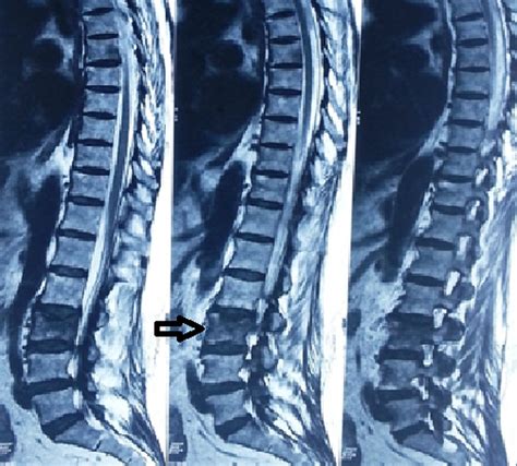 Cureus Multiple ‘brown Tumors Masquerading As Metastatic Bone Disease