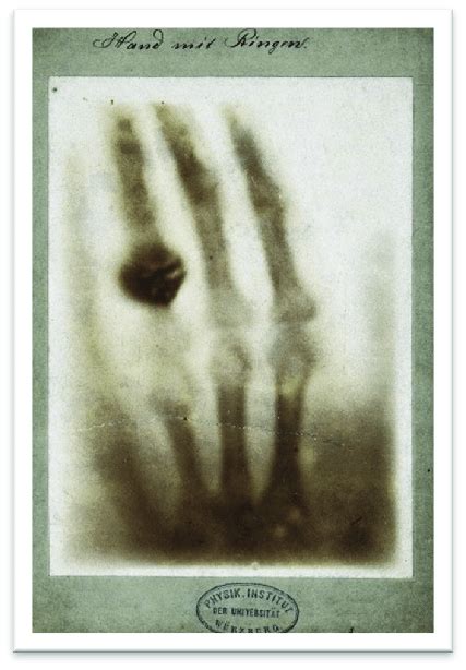 Wc Röntgens First Image Of His Wife´s Left Hand By Wilhelm C