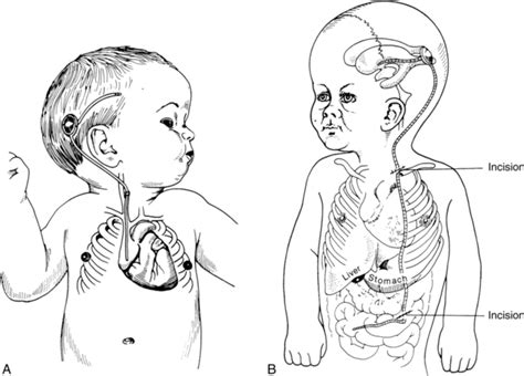 Spina Bifida A Congenital Spinal Cord Injury Musculoskeletal Key