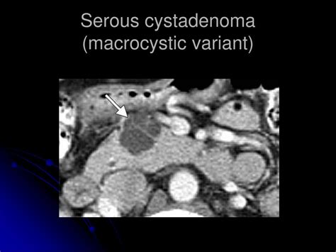 Ppt Imaging Of Pancreatic Cystic Lesions Powerpoint Presentation
