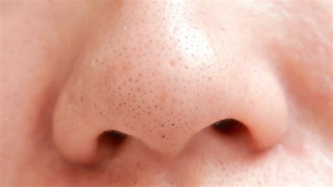 How To Get Rid Of Blackheads
