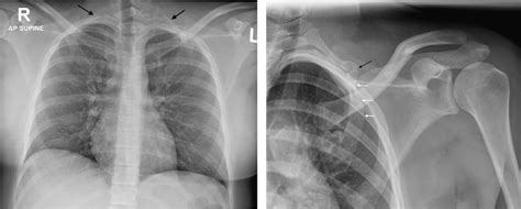 Left A Ap Chest Radiograph Shows Bilateral Cervical Ribs Right B