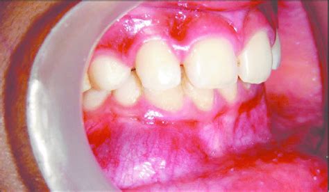 Intraoral Photograph Of The Patient Showing Soft Fluctuant Swelling On