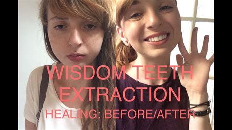 Wisdom Teeth Extraction Before And Afterhealing Process Youtube