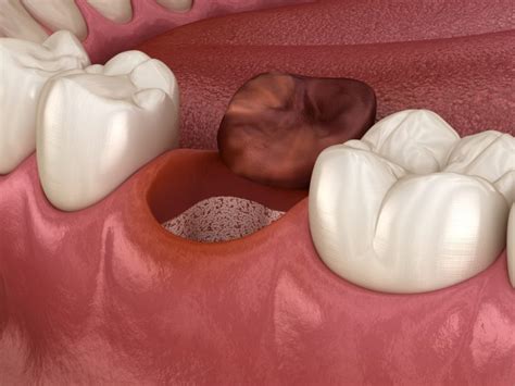 Alveolitis Dental Causas Síntomas Y Tratamientos