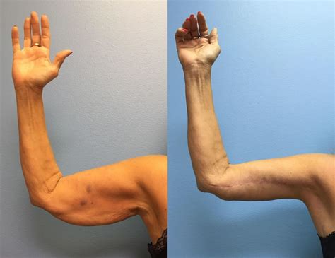 Arm Lift Surgery In Dubai Abu Dhabi And Sharjah Brachioplasty Dubai Cost