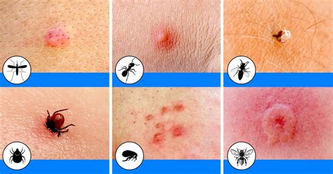 10 Bug Bites Anyone Should Be Able To Identify Bright Side