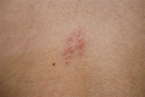 Shingles In Children Symptoms And Treatments