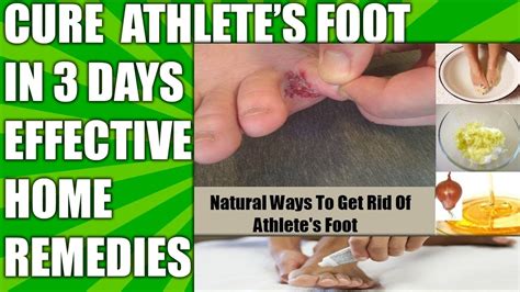 Best Home Remedies For Athletes Foot Fungus How To Cure Athletes Foot Fast Naturally At Home