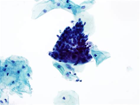 Pathology Outlines Atypical Glandular Cells Cytology