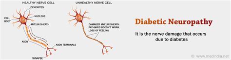 Diabetic Neuropathy Types Causes Symptoms Diagnosis Complication
