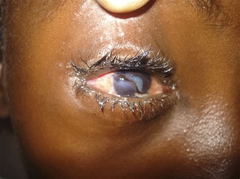 Penetrating Corneal Laceration Uvea In Wound Traumatic Cataract A