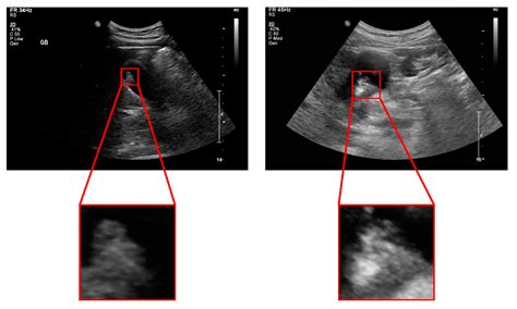 Diseased Gallbladder Ultrasound