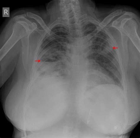 Plain Chest Radiograph Showing Cavitary Lesions In Both Lung Fields