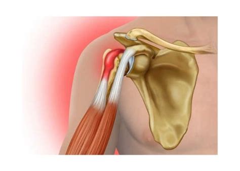 Arthroscopic Or Open Biceps Tenodesis Shoulder Surgeon South