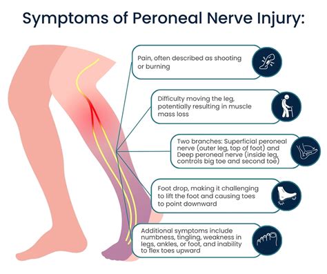 Peroneal Nerve Treatment In Nyc Pain Management Nyc