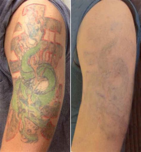 Laser Tattoo Removal Contour Dermatology