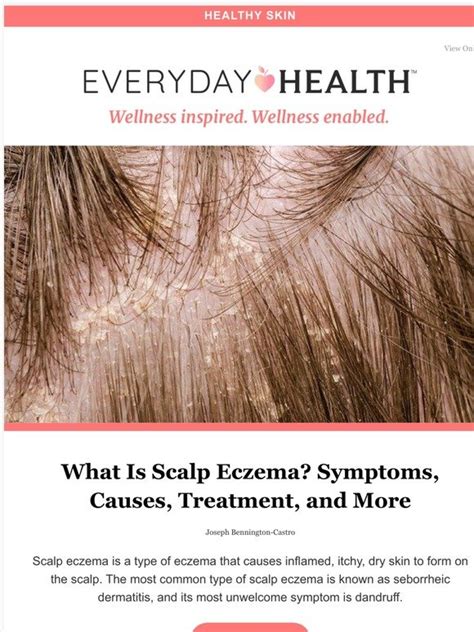 What Is Scalp Eczema Symptoms Causes Treatment And
