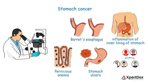 People no longer feel hungry and ultimately start losing weight without trying, says dr. What is Stomach Cancer? - YouTube
