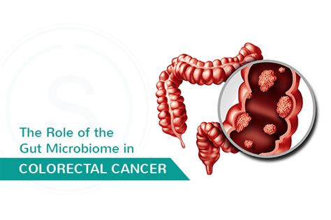 Role Of The Gut Microbiome In Colorectal Cancer Smiles