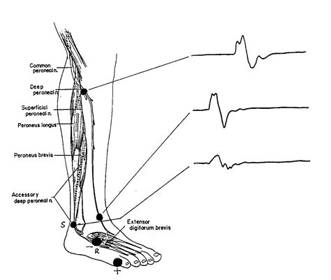 N Fibularis Peroneus Profundus Motorisk Neurografi