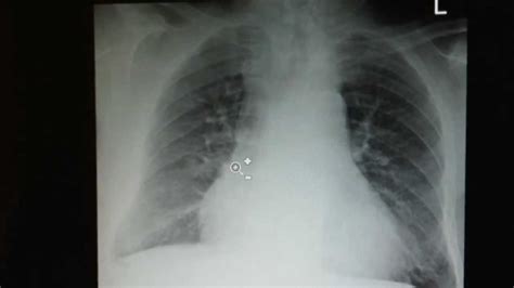 Copd How To Recognize It On A Chest X Ray Youtube