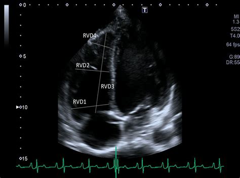 Association Of Echocardiographic Parameters Of Right Ventricular