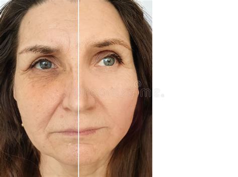 Woman Face Wrinkles Aging Before And After Treatment Swollen Stock