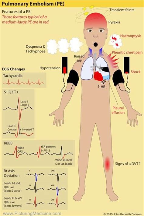 Signs And Symptoms Of Pulmonary Embolism PE Pulmonary GrepMed